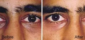 Under Eye Dark Circles Treatments9