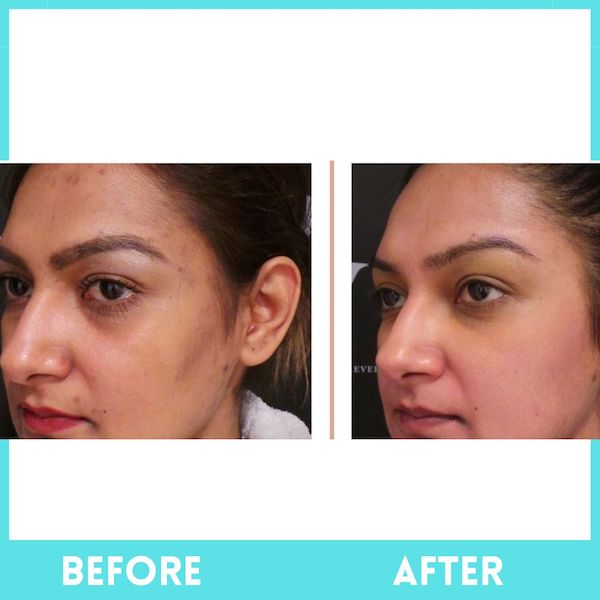 Advanced Skin Tightening, Wrinkles & HIFU Treatment In Delhi - 2