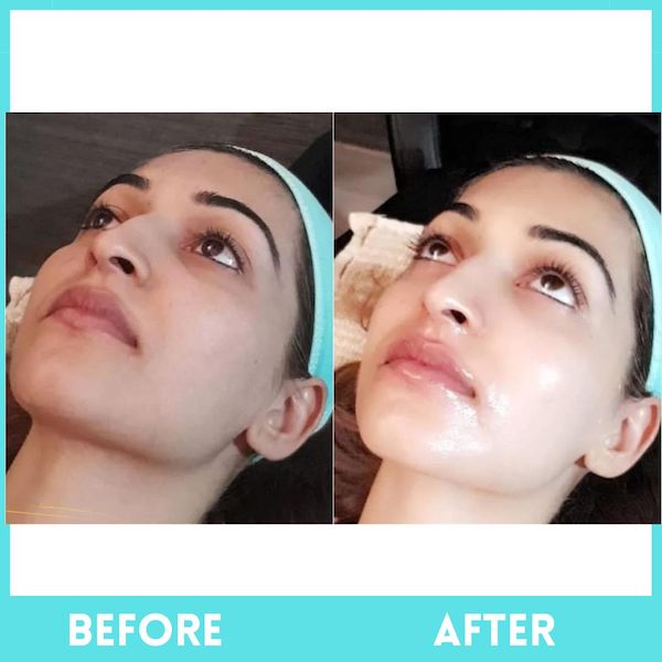 Advanced Skin Tightening, Wrinkles & HIFU Treatment In Delhi - 3