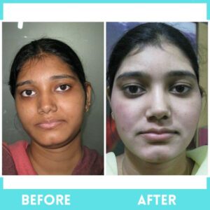 Advanced Skin Whitening Treatment - 1