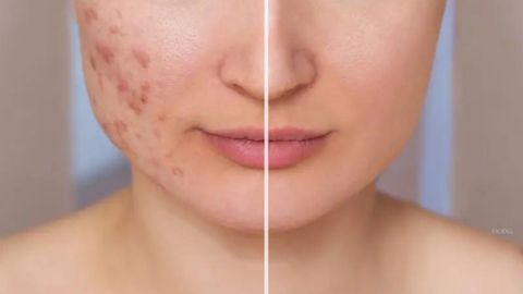 acne scar treatment in delhi