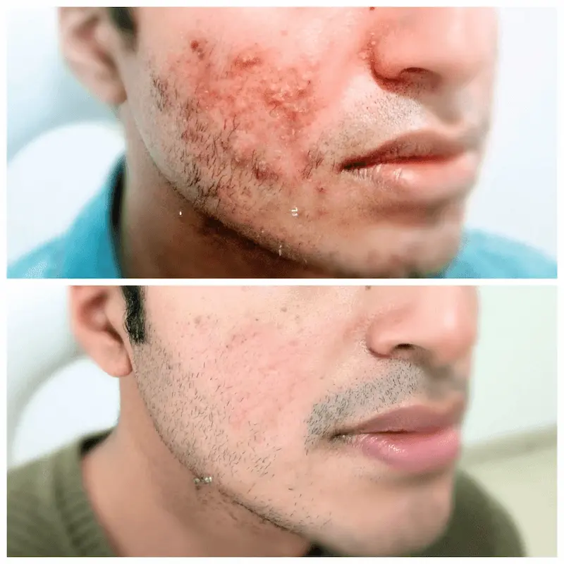 acne treatment in delhi