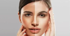 skin whitening laser Treatment